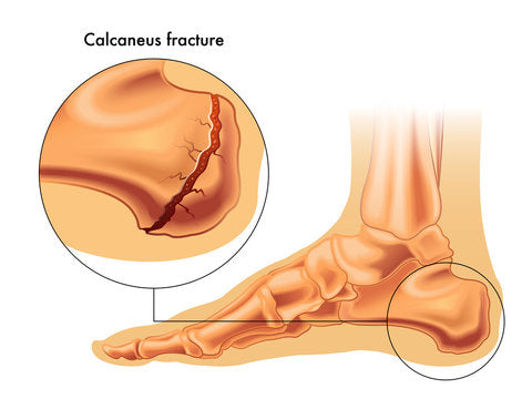 Life After a Calcaneus Fracture: What to Expect and How to Move Forward