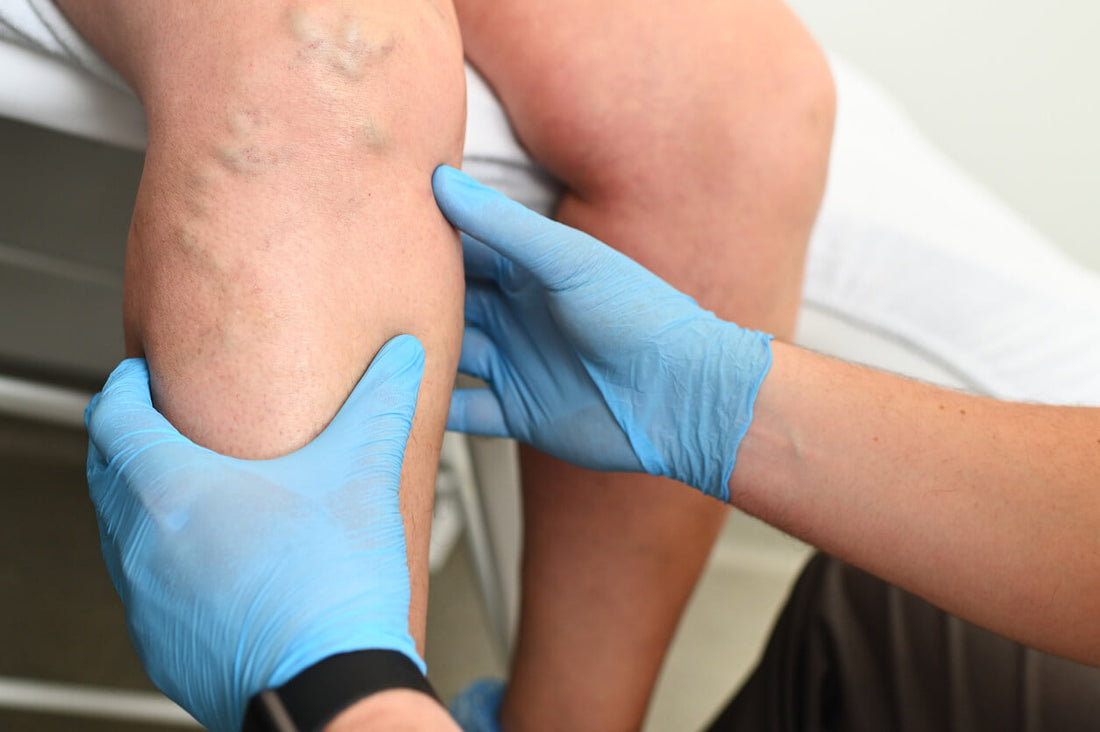 LYMPHEDEMA