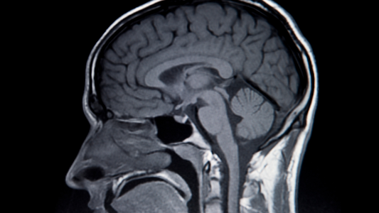 6 stages of concussion recovery​