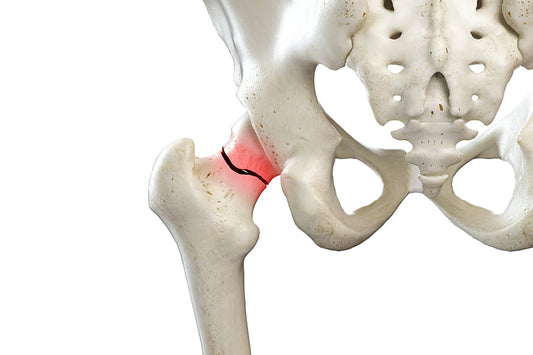 Hip Rehabilitation