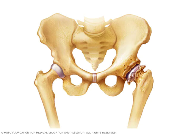 Physiotherapy and Osteoarthritis of the Hip: How does it work?